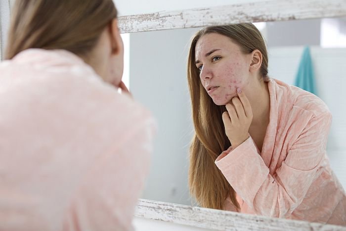 Young,Woman,With,Acne,Problem,Near,Mirror,In,Bathroom