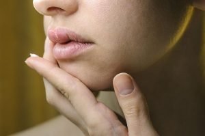 Herpes on the Upper Lip of a Young Woman